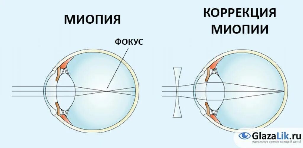 Коррекция зрения с помощью линз. Миопия средней степени одного глаза. Очки для коррекции зрения близорукость. Схема коррекции зрения при близорукости. Двояковогнутая линза для близорукости.