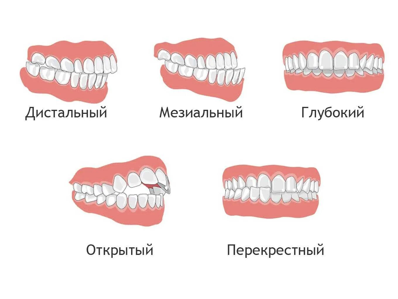 Почему зубы отличаются между собой у разных. Правильный прикус зубов у человека схема. Правильный прикус у человека схема сбоку. Зубы прикус неправильный неправильный. Как выглядит правильный прикус зубов.