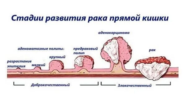 Рак 4 стадия сколько живут форум. Стадии развития онкологии. Аденокарцинома 1а стадия. Полиповидные разрастания. 4 Стадии аденокарциномы матки.
