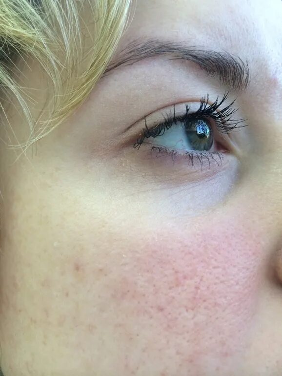 Папуло пустулезная розацеа. Под вечер краснеют щеки. Эритематозно-телеангиэктатическая розацеа. Розацеа папулопустулы. Под вечер краснеют щеки.