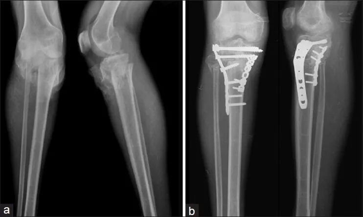 Перелом большой берцовой мыщелки. Внутрисуставной перелом большеберцовой кости рентген. Перелом наружного мыщелка берцовой кости. Остеосинтез медиального мыщелка большеберцовой кости винтами. Остеосинтез при переломе мыщелков большеберцовой кости.