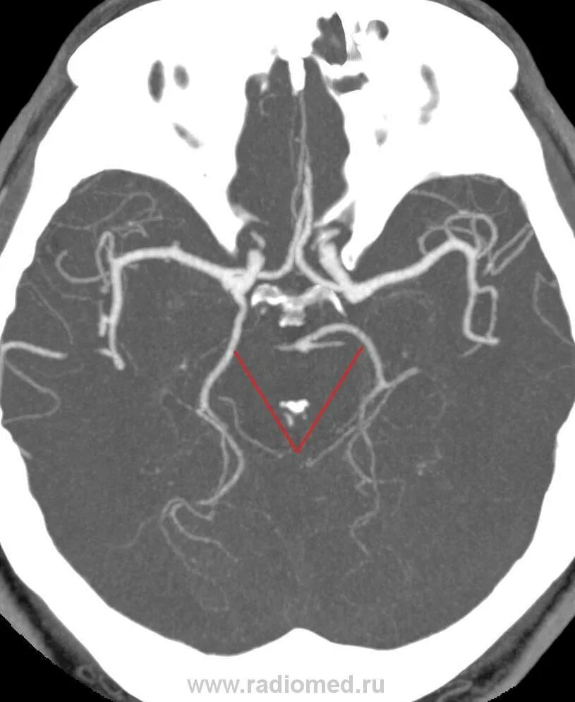Правая задняя трифуркация. Персистирующая тригеминальная артерия. Задняя трифуркация ВСА кт. Персистирующая тригеминальная артерия мрт.