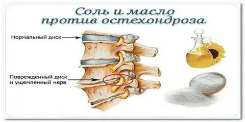 Остеохондроз соли