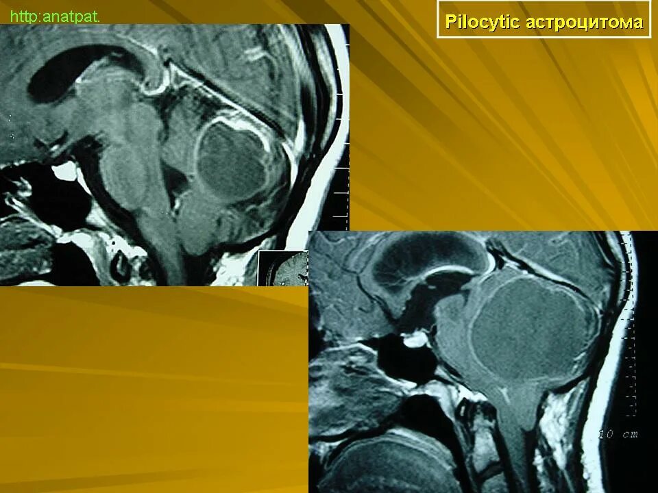 Пилоидная астроцитома. Пилоцитарная астроцитома кт. Пилоцитарная астроцитома мрт. Пилоидная астроцитома мозжечка. Астроцитома мозжечка мрт.