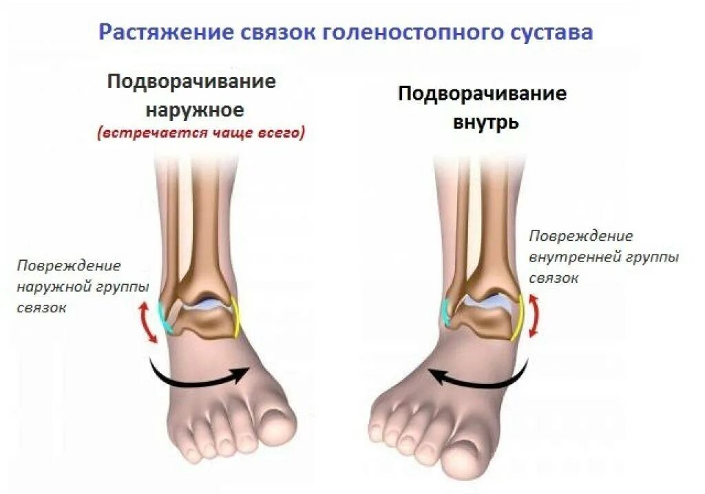 Растяжение связок голеностопного сустава сколько