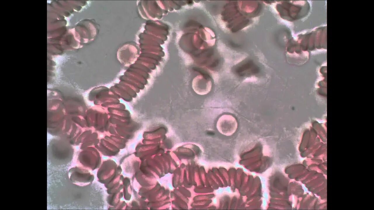 Сладж эритроцитов. Монетные столбики эритроцитов стаз. монетные столбики эритроцитов и агглютинация. агглютинация эритроцитов в виде монетных столбиков. монетные столбики - слипшиеся эритроциты.