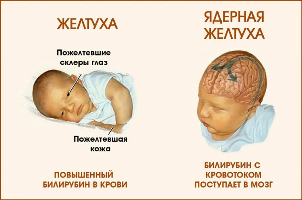 Желтушка у новорожденных причины. У новорожденного желтуха что делать. У новорожденного желтуха что делать. Физиологическая желтушка у новорожденных причины. Желтушность у новорожденных.