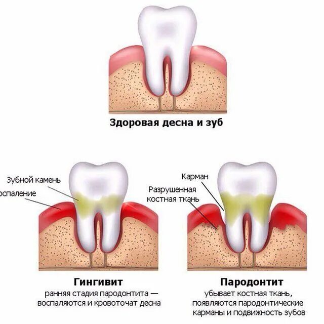 Кровоточивость десен гингивит. Почему кровоточат зубы и десны. Кровоточивость десен гингивит. Повышенная кровоточивость десен. Кровоточивость десен гингивит.