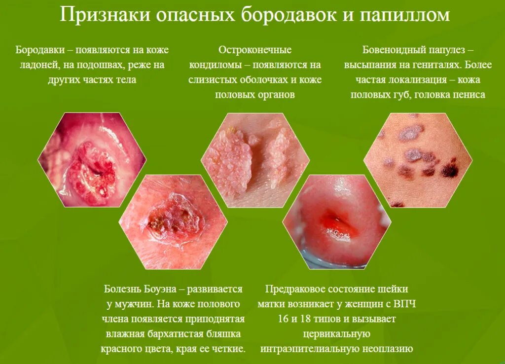 Плоскоклеточное поражение низкой степени. Остроконечнаякандилома. Папилломавирусная инфекция.