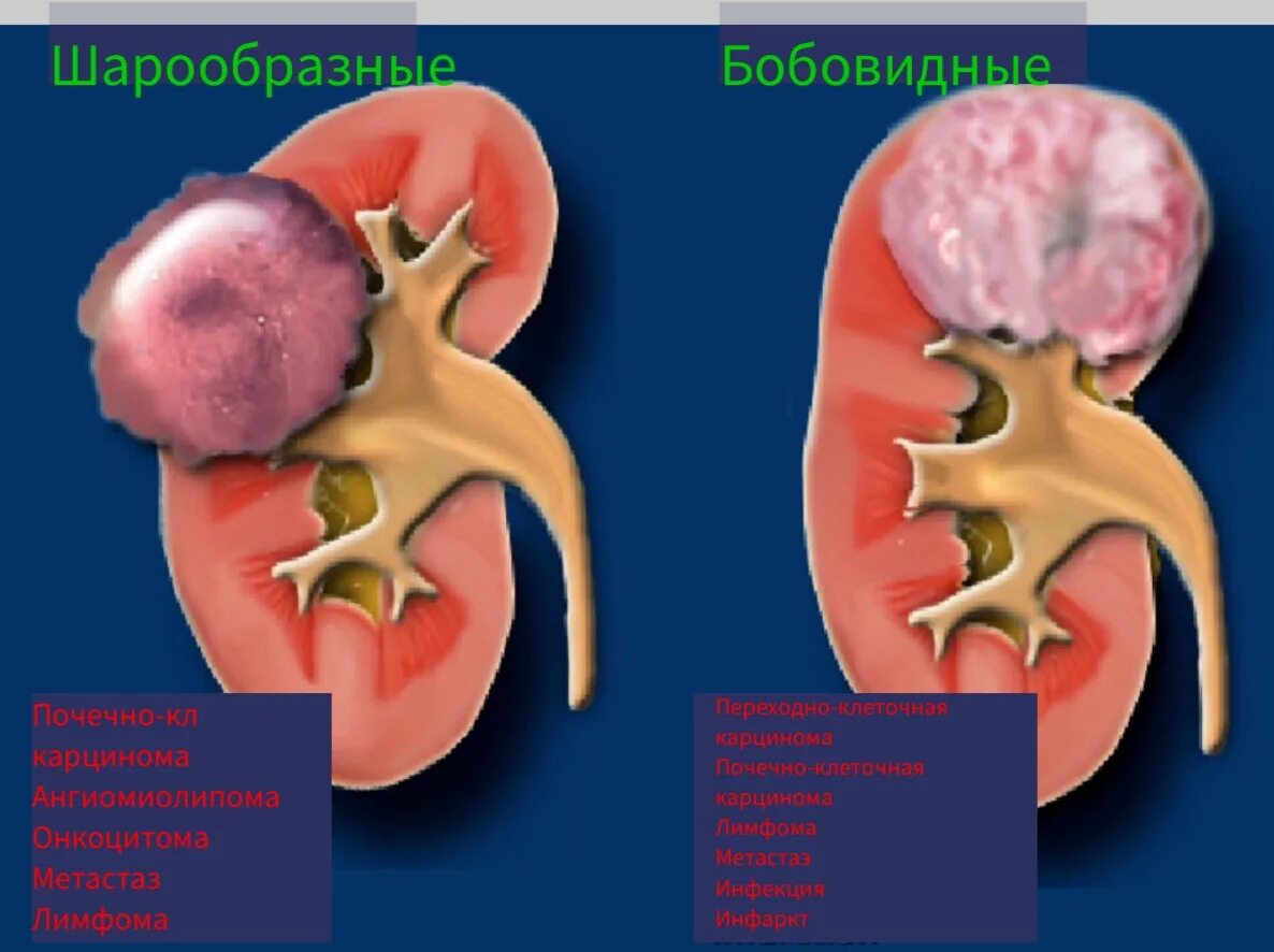 Образования в почке у мужчин. Доброкачественные образования почек. Объемное образование почки. Доброкачественные и злокачественные опухоли почек.