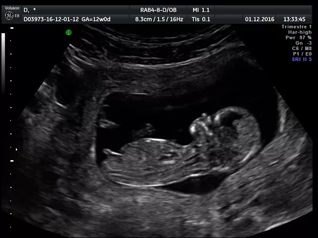 Фото мальчика 12 недель. Мальчик и девочка на УЗИ В 12 недель беременности. УЗИ 12 недель беременности мальчик. Снимок УЗИ беременности 12 недель девочка. УЗИ мальчик 12-13 недель беременности.