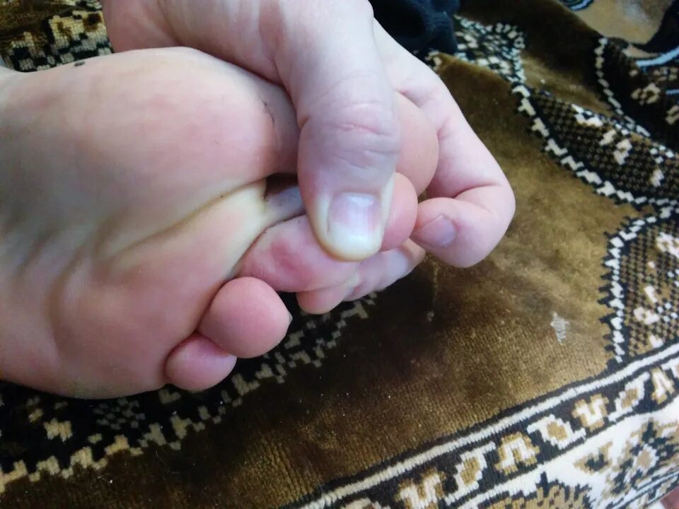 Межпальцевый грибок: признаки, методы лечения, фото