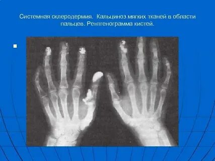 Мягкие ткани кисти рук