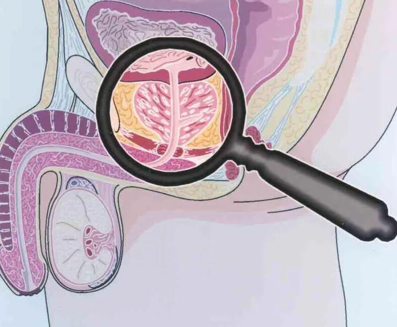 Простатит предстательной железы. Хронический простатит. Простата рисунок. Нарушение предстательной железы