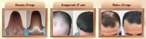 Для усиленного роста волос на голове