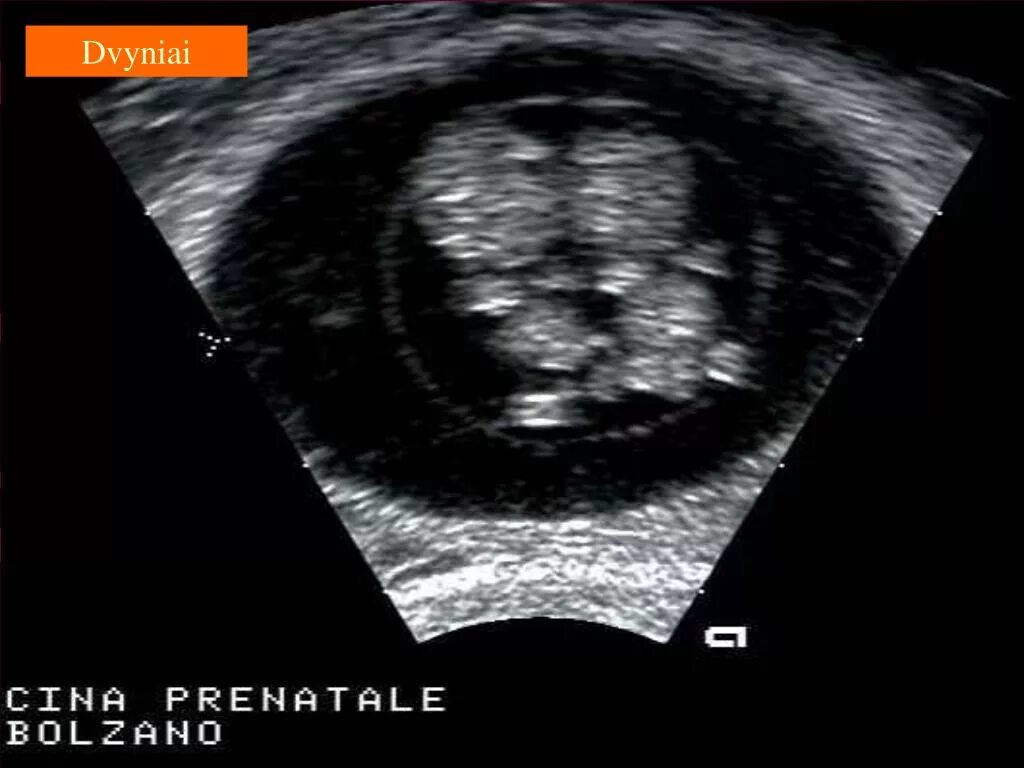 Близнецы 11 недель. УЗИ двойни однояйцевые. Многоплодная беременность на УЗИ 7 недель. Однояйцевая беременность двойней на УЗИ. УЗИ 12 недель беременности двойня.