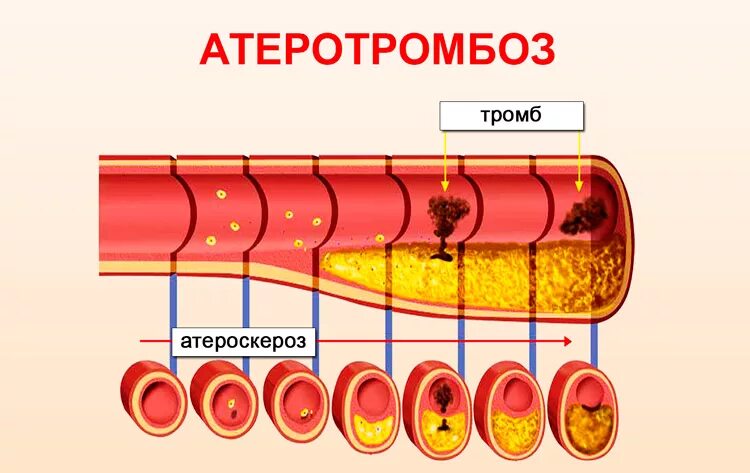 Атеротромбоз патогенез. Атеросклероз и Атеротромбоз. Виды тромбов. Тромб и бляшка разница