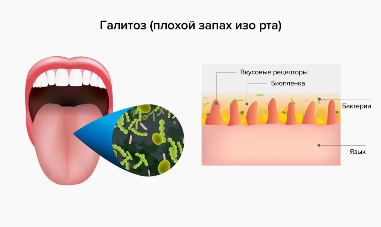 Вкус яиц во рту. Галитоз неприятный запах изо рта. Запах изо рта (халитоз) у детей.