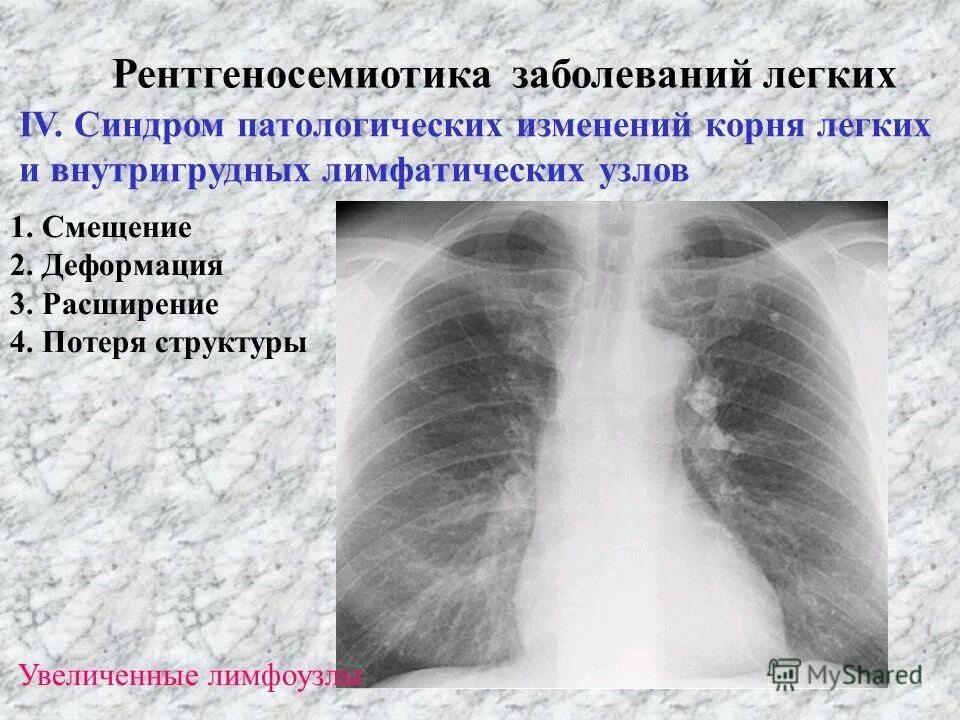 Уплотнена деформирована