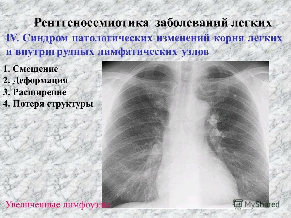 Корни малоструктурные что значит. Синдром патологии легочного рисунка. Заболевания корня легкого. Корни лёгких на рентгенограмме.