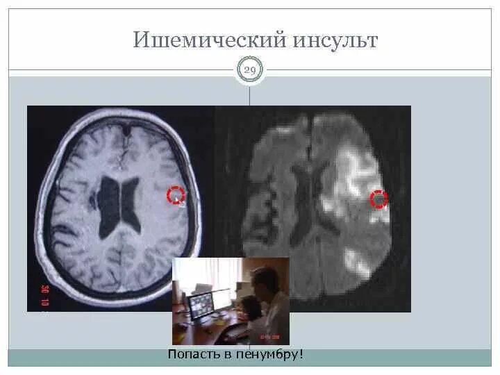 Ишемический инсульт Пенумбра. Ишемический инсульт кт.