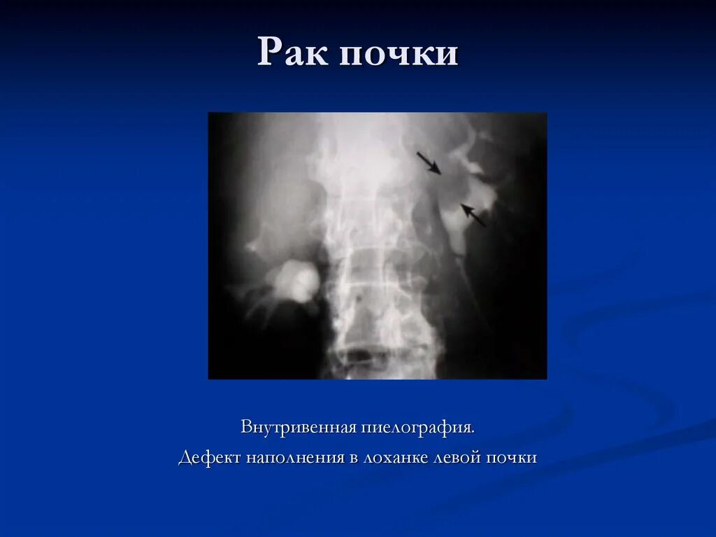 Дефект наполнения в почечной лоханке. Опухоль почечной лоханки лучевая диагностика. Почечная лоханка на рентгене. Опухоли почек рентгенодиагностика.