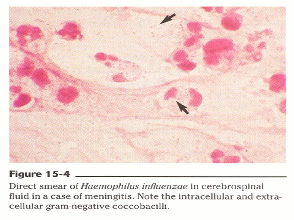 Haemophilus в мазке у мужчин. Haemophilus influenzae микробиология. Haemophilus influenzae факторы вирулентности. Haemophilus influenzae тинкториальные. Гемофильная палочка микробиология.