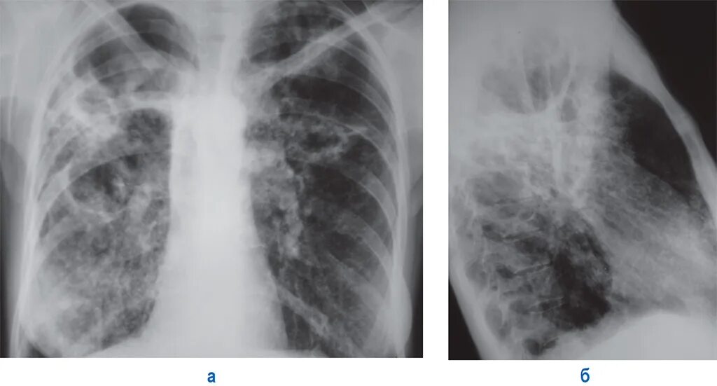 Фиброзно-кавернозный туберкулез рентген. Туберкулез каверны рентгенограмма. Туберкулезная каверна рентген. Каверна туберкулез рентген.