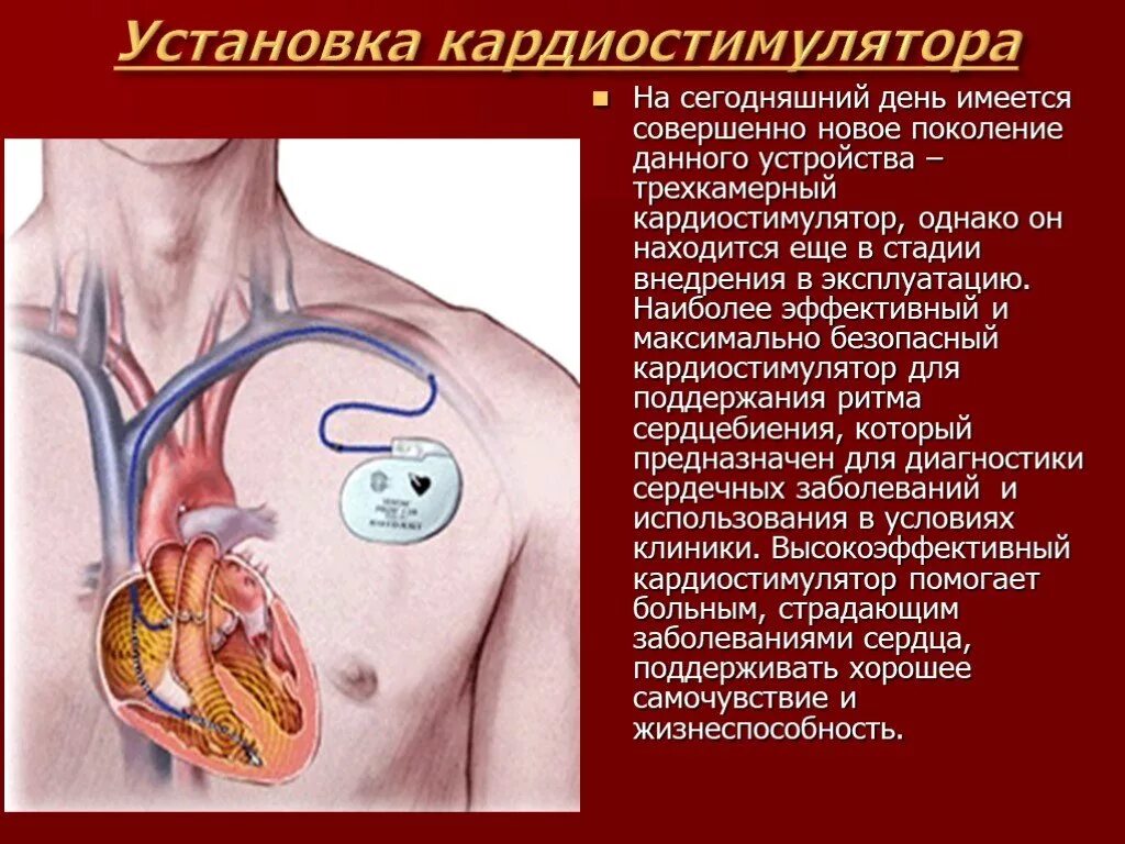 Кардиостимулятор сердца. Установленный кардиостимулятор. Кардиостимулятор операция. Трехкамерный кардиостимулятор сердца.
