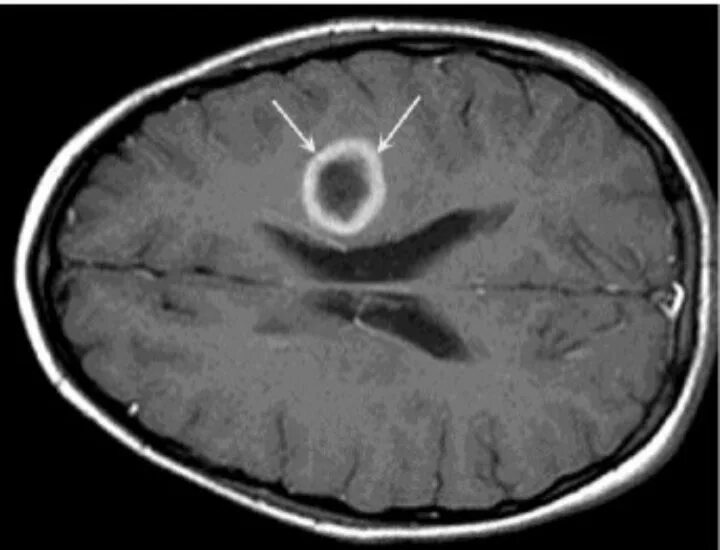 Атрофия головного мозга 1. Внутримозговой абсцесс. Метастатический абсцесс головного мозга. Абсцесс головного мозга этиология.