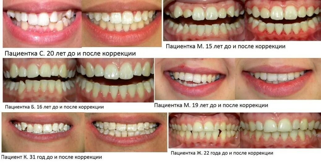 Брекеты сроки