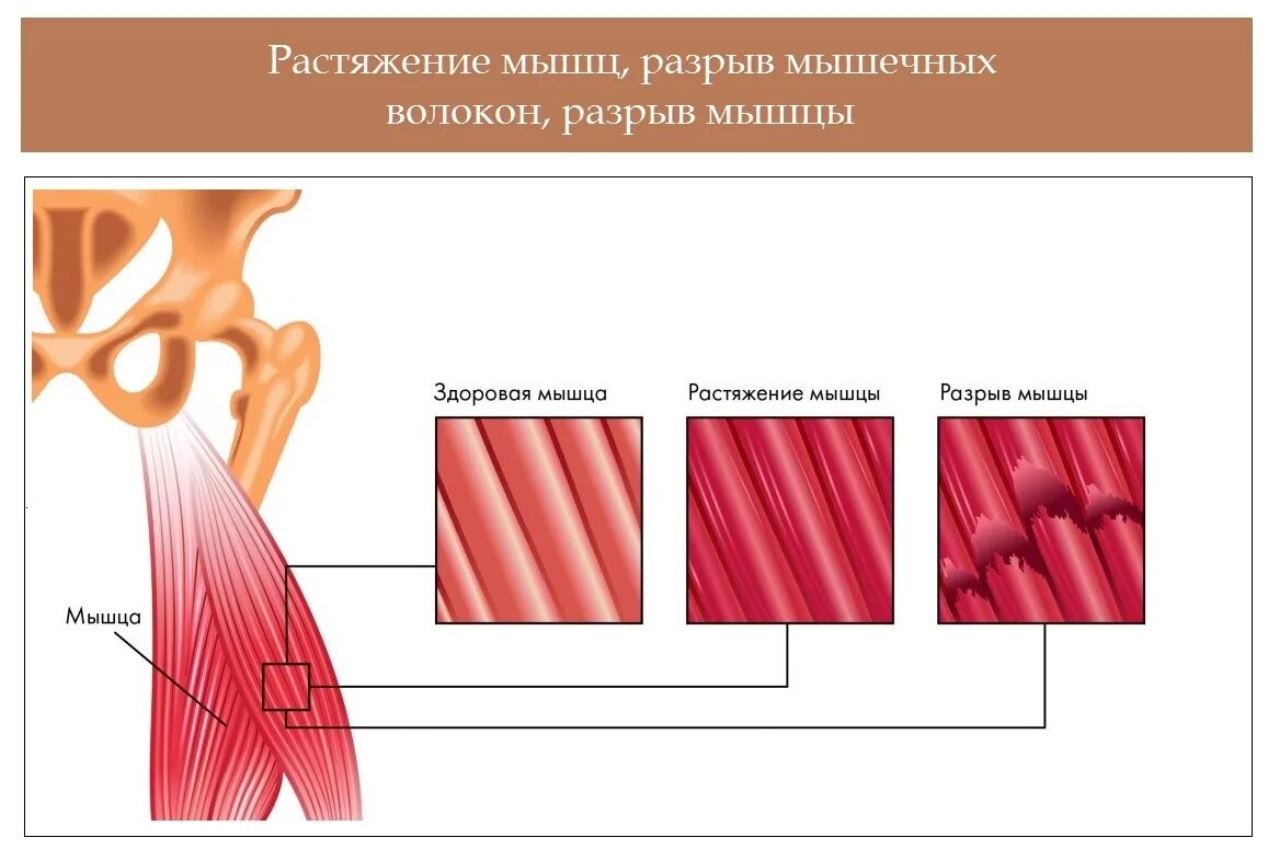 Разрыв мышечных волокон. Микроразрывы мышечных волокон.
