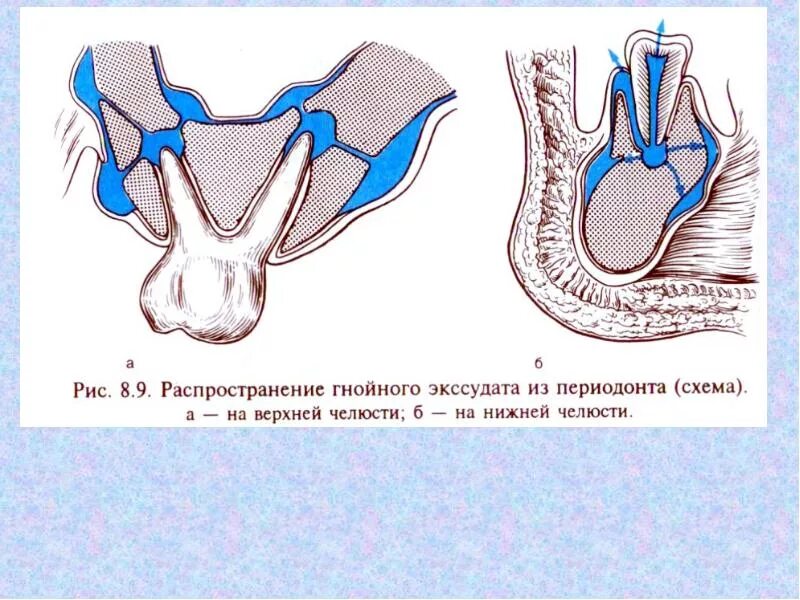 Отток экссудата. Пути оттока экссудата из периодонта. распространение гнойного экссудата из периодонта. пути распространения гнойного экссудата из периодонта.. отток гнойного экссудата из корня.