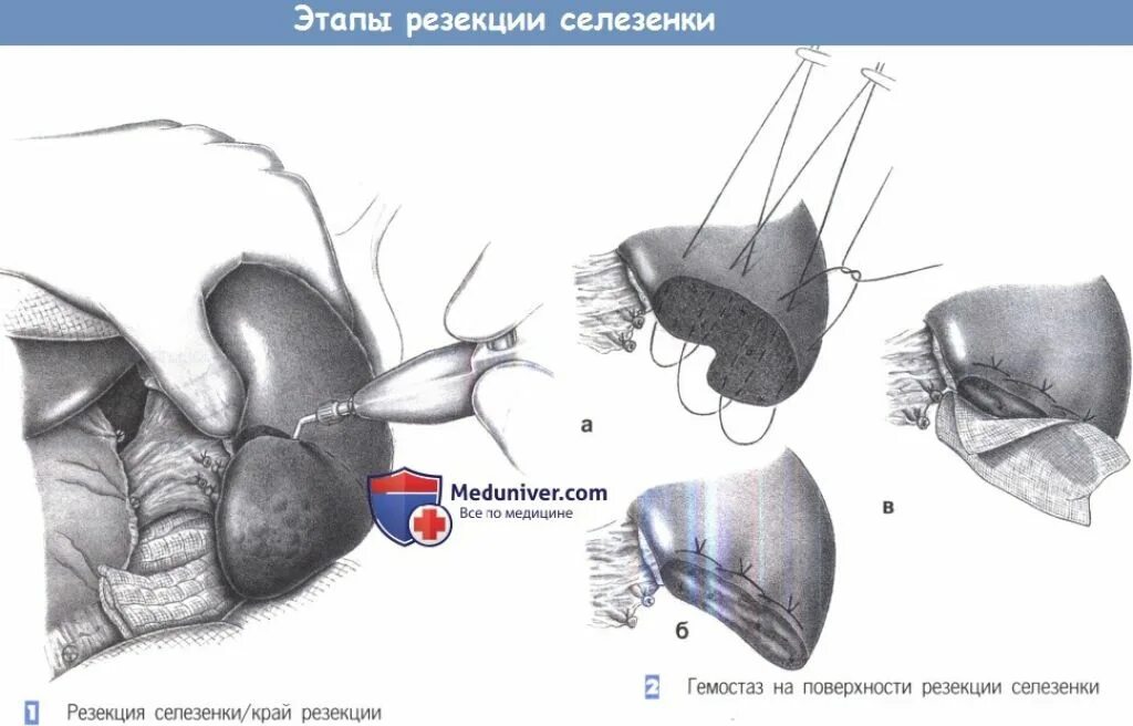 Операция резекция печени. Резекция селезенки техника. Клиновидная резекция селезенки. Атипичная резекция печени. Атипичная резекция селезенки.