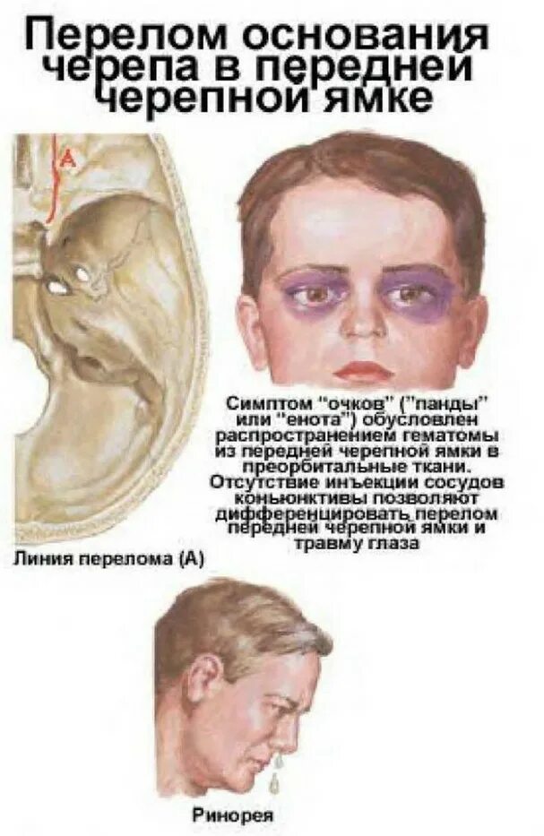 проявление перелома черепа. переломы костей свода черепа клиника. «симптом баттла» при переломах основания черепа. перечислите симптомы перелома основания черепа. симптомы при переломе черепа.