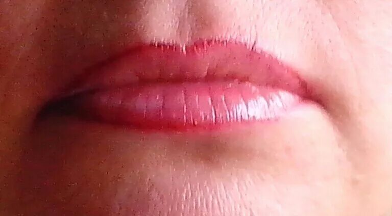 Воспаление каймы губ (хейлит). Эксфолиативный хейлит. Лимфоэдематозный хейлит. Верхний край губы