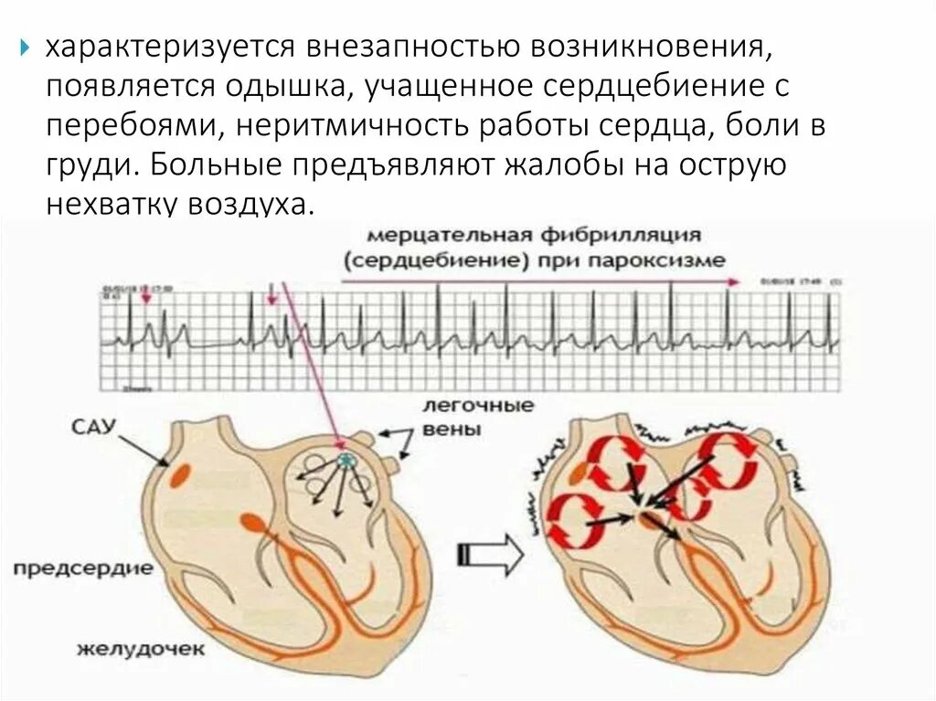 Сильно стучит сердце что делать. Пароксизмальная форма фибрилляции предсердий. Пароксизмальная аритмия. Одышка и сердцебиение. Фибрилляция предсердий схема.