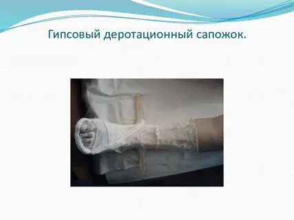 Гипс сапожок при переломе