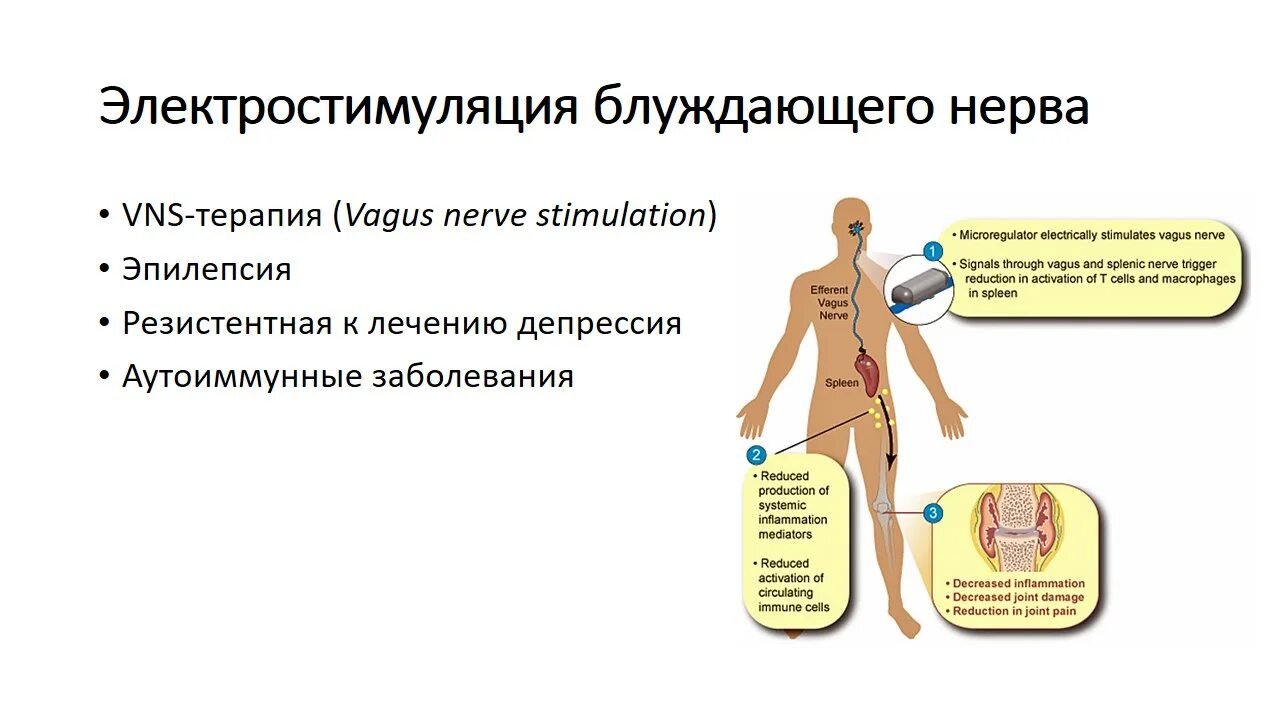 Стимулятор блуждающего нерва. Электрическая стимуляция блуждающего нерва. Блуждающий нерв стимуляция. Стимуляция блуждающего нерва при эпилепсии. Вагус стимулятор блуждающего нерва.