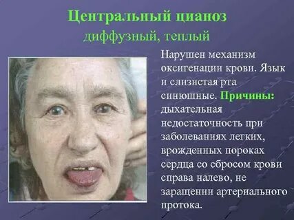 Цианотичный оттенок слизистой