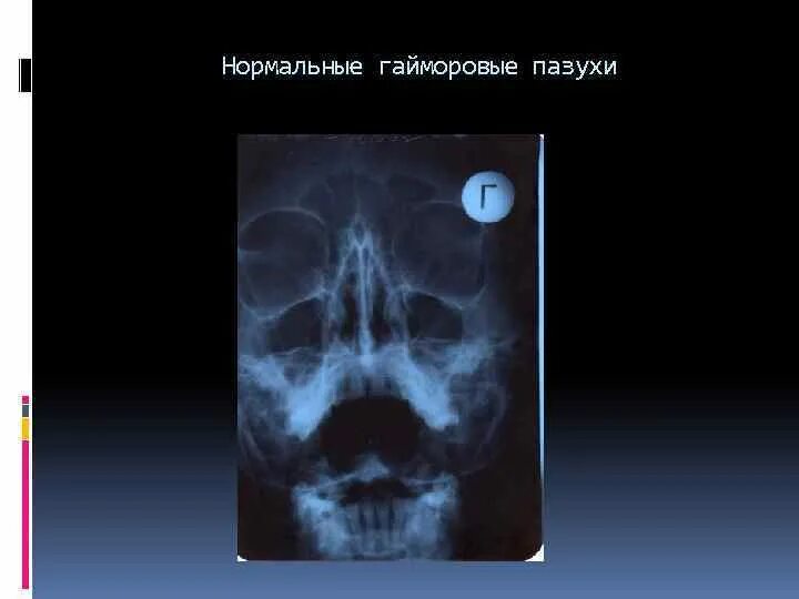 Область гайморовой пазухи. Область гайморовой пазухи