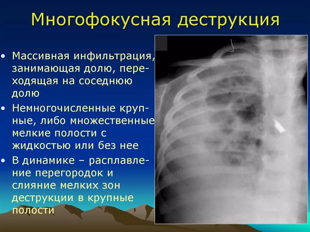 Зона деструкции