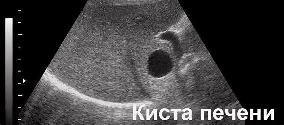 Киста печени лечение отзывы
