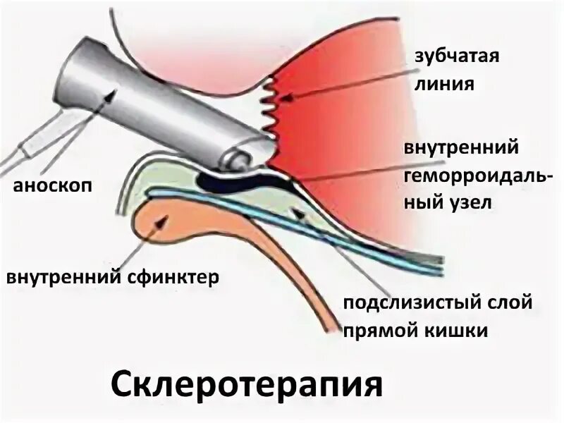 Инфракрасная коагуляция геморроидальных узлов. Инфракрасная фотокоагуляция геморроя. Склеротерапия геморроидальных узлов. Инфракрасная фотокоагуляция внутренних геморроидальных узлов.