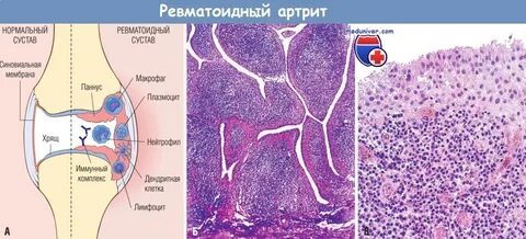Ревматоидный артрит микропрепарат