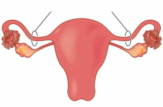 Если месячные если перевязать трубы. Хирургическая стерилизация маточных труб. Перевязка маточных труб. Гистероскопическая перевязка маточных труб. Перевязка фаллопиевых труб.