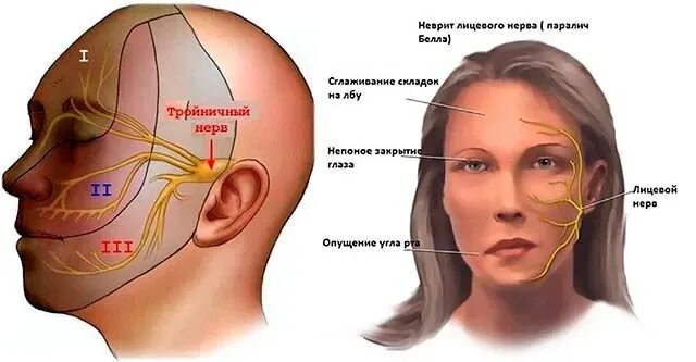 Онемевает правая сторона лица. Воспаление тройничного лицевого нерва. Тройничный лицевой нерв.