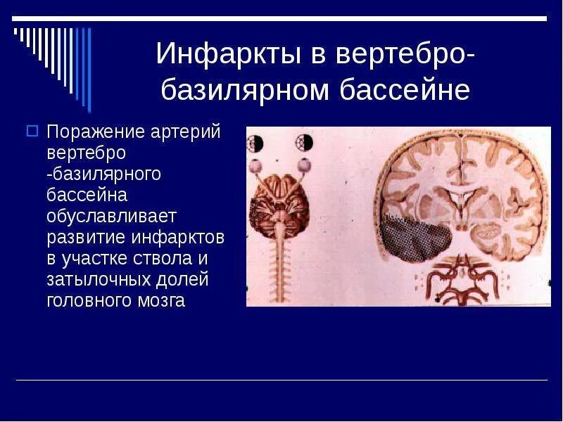 Вертебро базилярная инсульт. Вертебробазилярный бассейн головного мозга ишемический инсульт. Вертебробазилярный бассейн инсульт. ОНМК В вертебро базилярном бассейне. Вкртебрально базиальный бассейн.