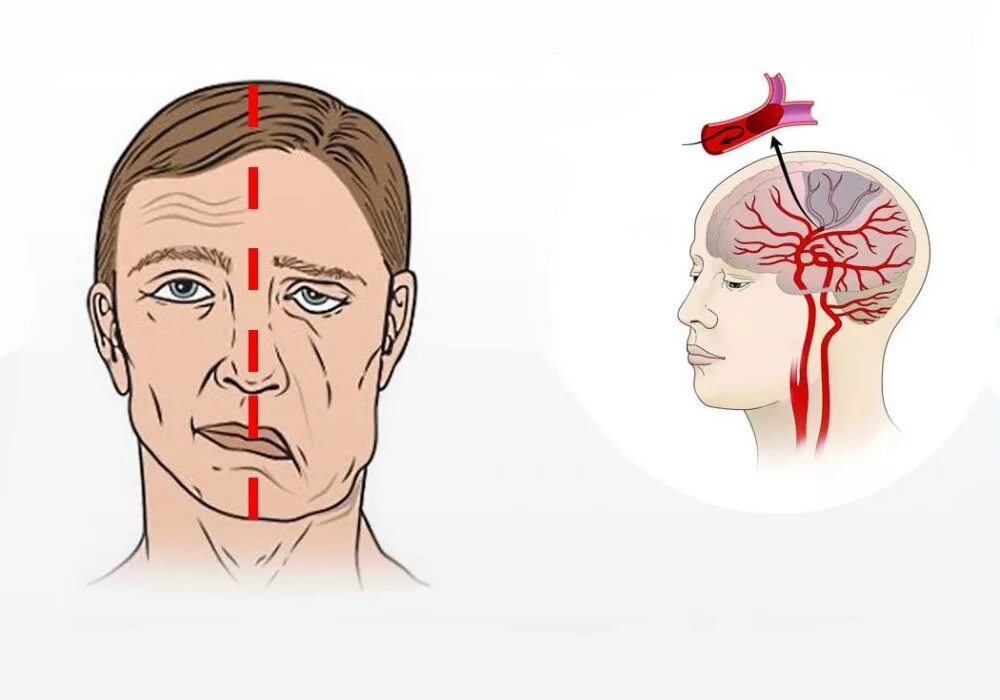 Шишки после инсульта. Инсульт картинки. Ишемический инсульт картинки. Исудьт.