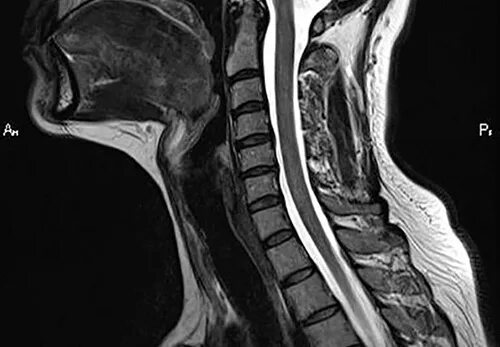 Мрт шейного отдела позвоночника по времени. Мрт шейного отдела. Мрт шейного отдела позвоночника. Мрт шейно-грудного отдела. Снимки мрт шейного отдела.